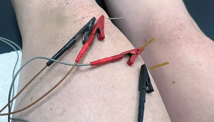 This patient is receiving electric stimulation therapy.