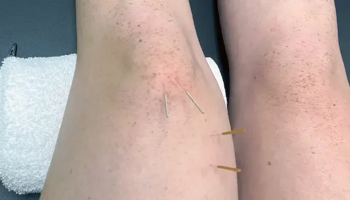 A patient with dry needling treatment.