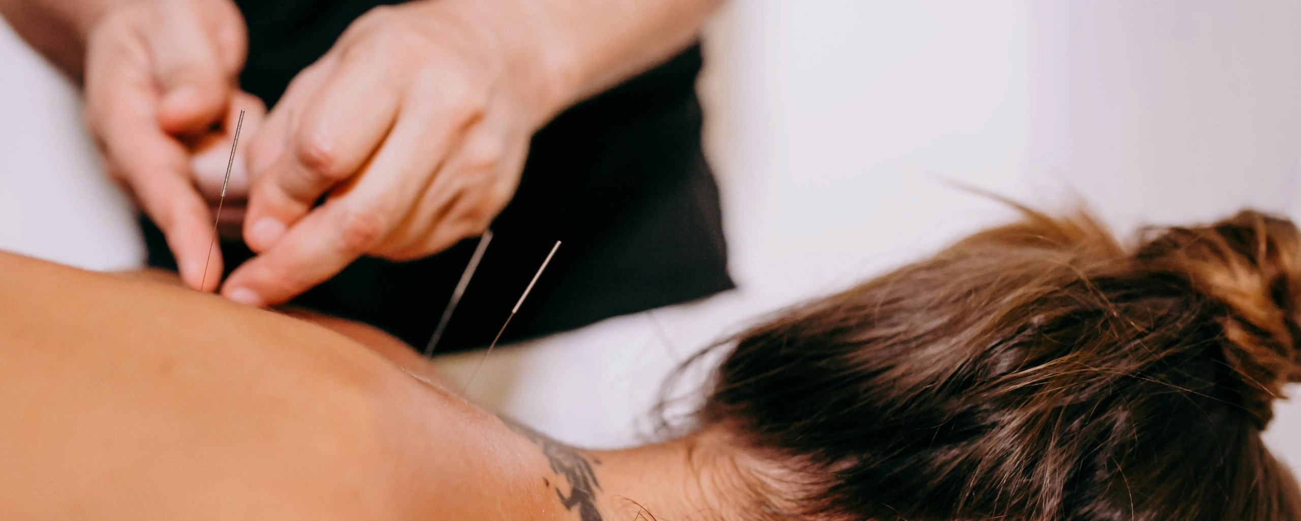 Dry Needling